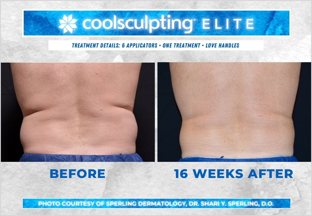 Before & After Love Handles CoolSculpting in New Jersey