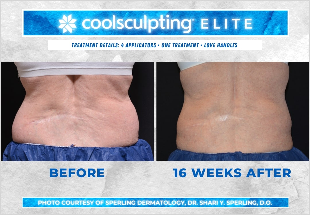 Before & After Love Handles CoolSculpting in New Jersey