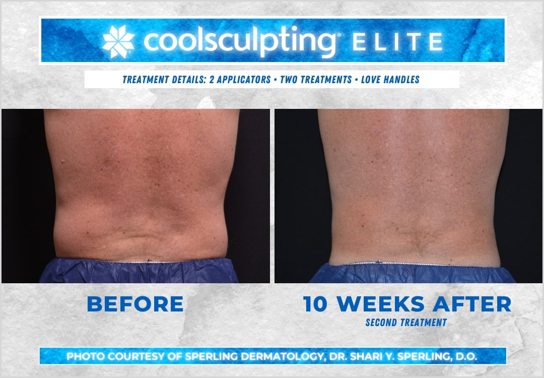 Before & After Love Handles CoolSculpting in New Jersey