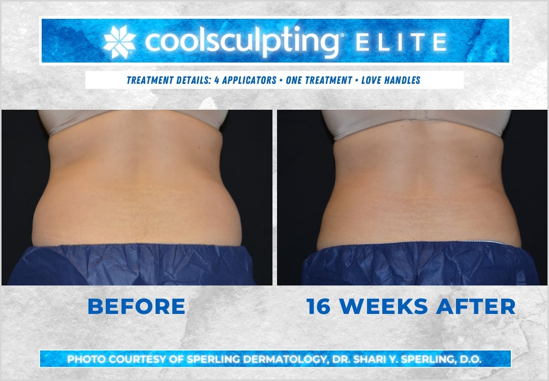 Before & After Love Handles CoolSculpting in New Jersey