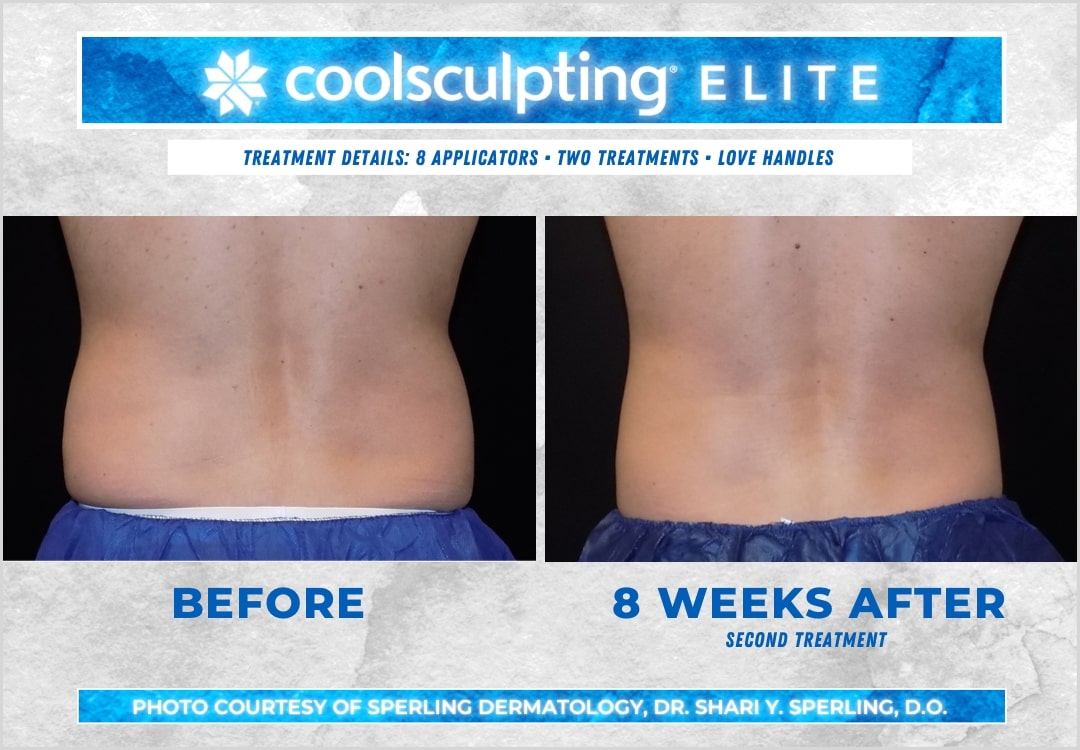 Before & After Love Handles CoolSculpting in New Jersey