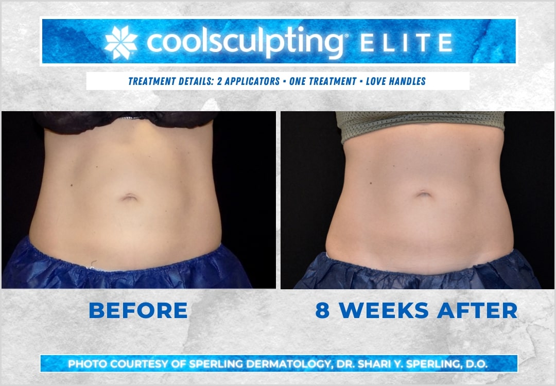 Before & After Love Handles CoolSculpting in New Jersey