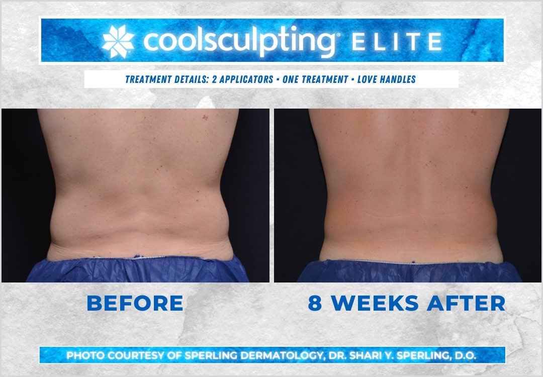 Before & After Love Handles CoolSculpting in New Jersey