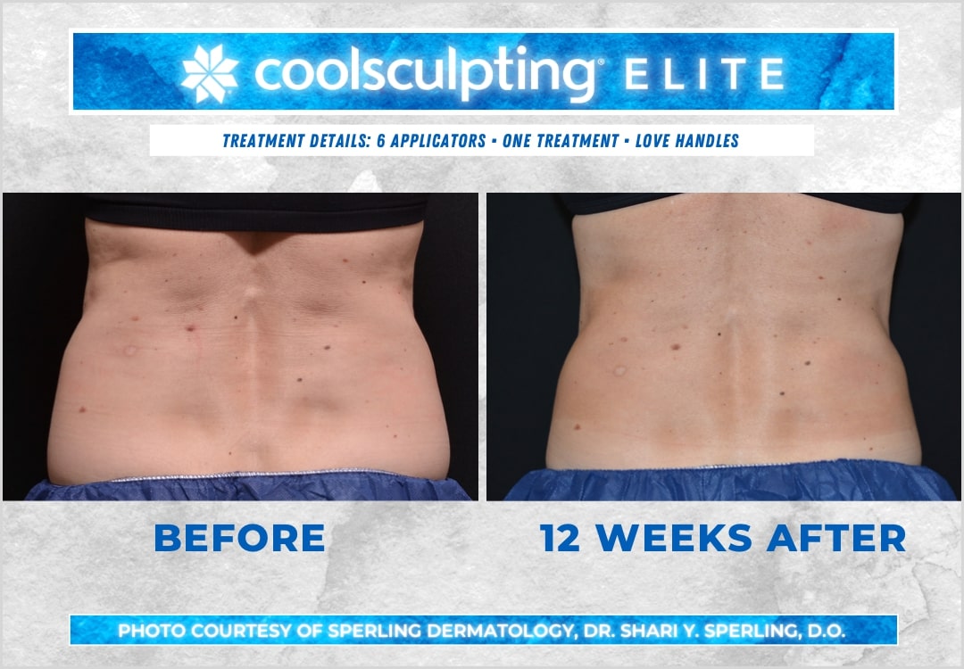 Before & After Love Handles CoolSculpting in New Jersey