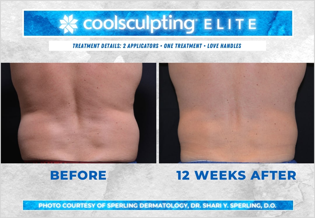 Before & After Love Handles CoolSculpting in New Jersey