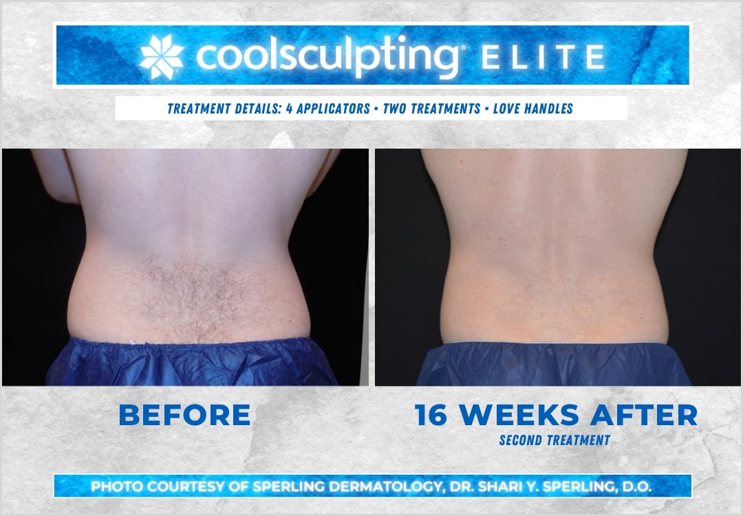 Before & After Love Handles CoolSculpting in New Jersey