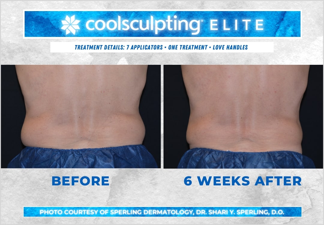 Before & After Love Handles CoolSculpting in New Jersey