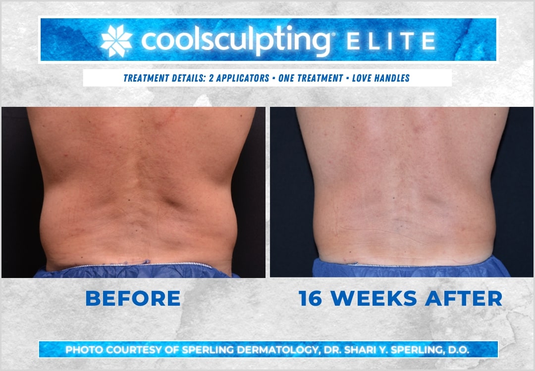 Before & After Love Handles CoolSculpting in New Jersey