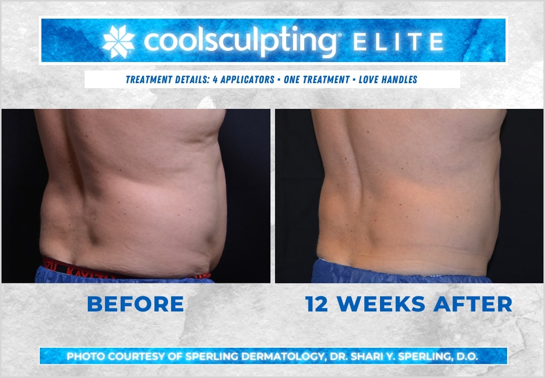 Before & After Love Handles CoolSculpting in New Jersey