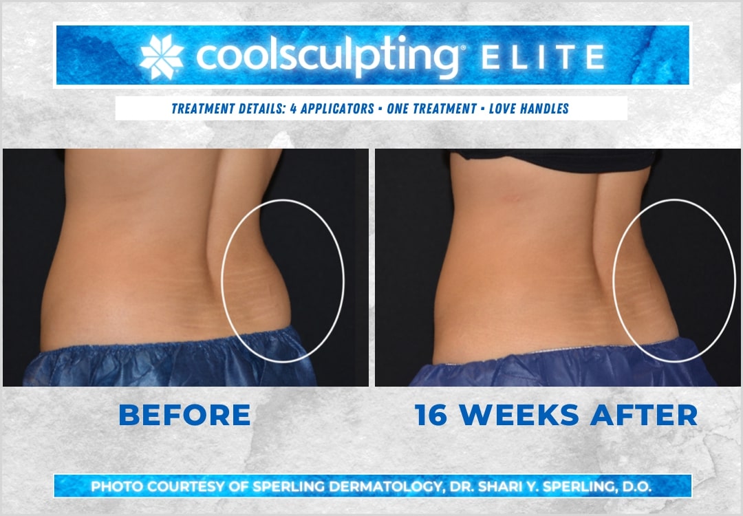 Before & After Love Handles CoolSculpting in New Jersey