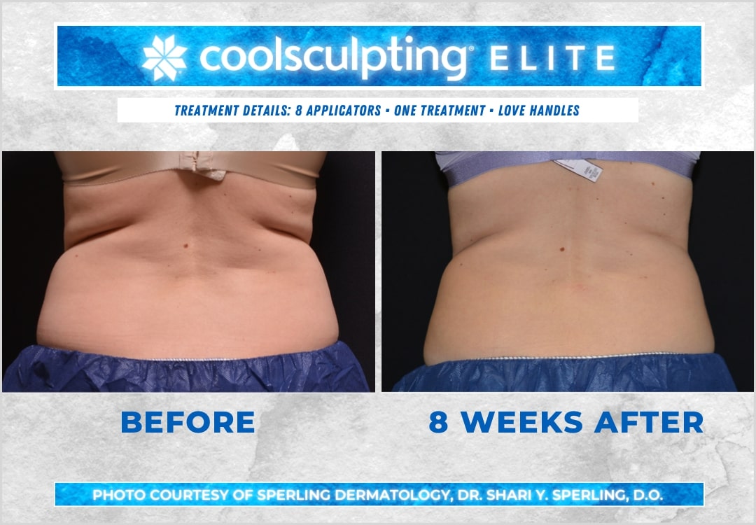 Before & After Love Handles CoolSculpting in New Jersey