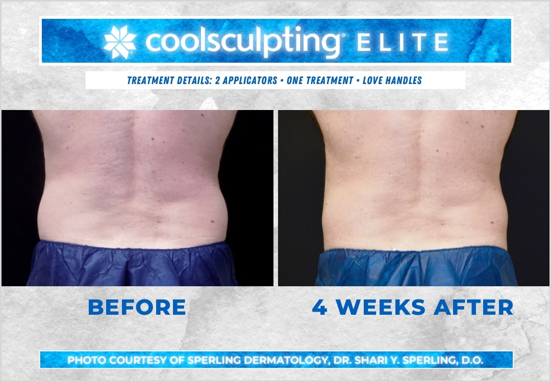 Before & After Love Handles CoolSculpting in New Jersey