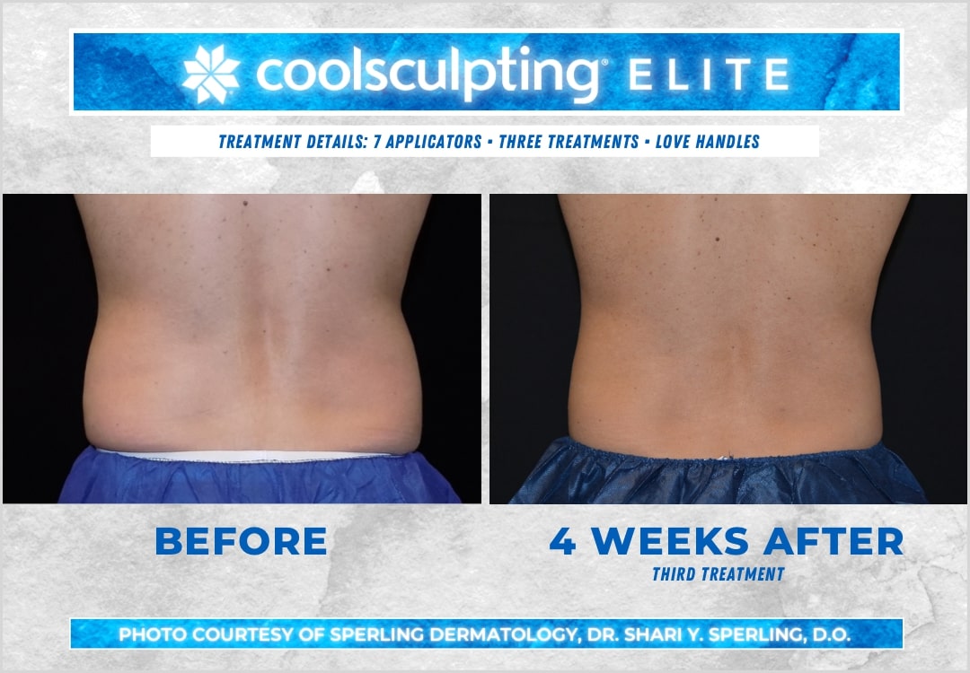 Before & After Love Handles CoolSculpting in New Jersey