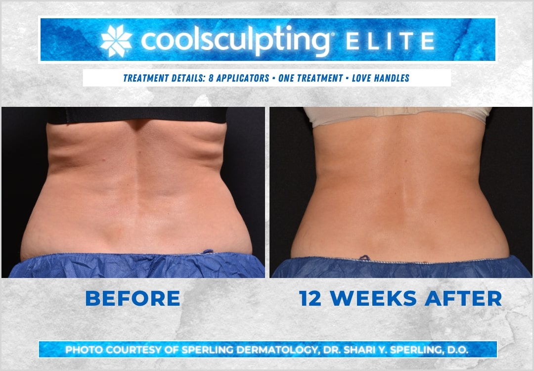 Before & After Love Handles CoolSculpting in New Jersey