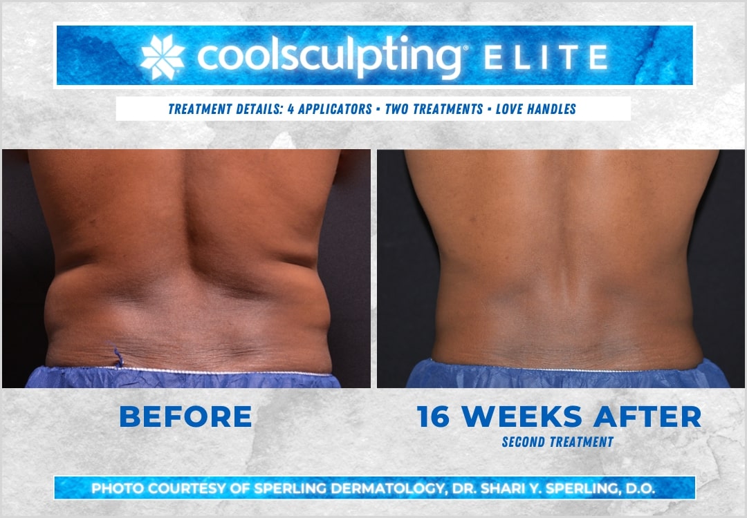 Before & After Love Handles CoolSculpting in New Jersey