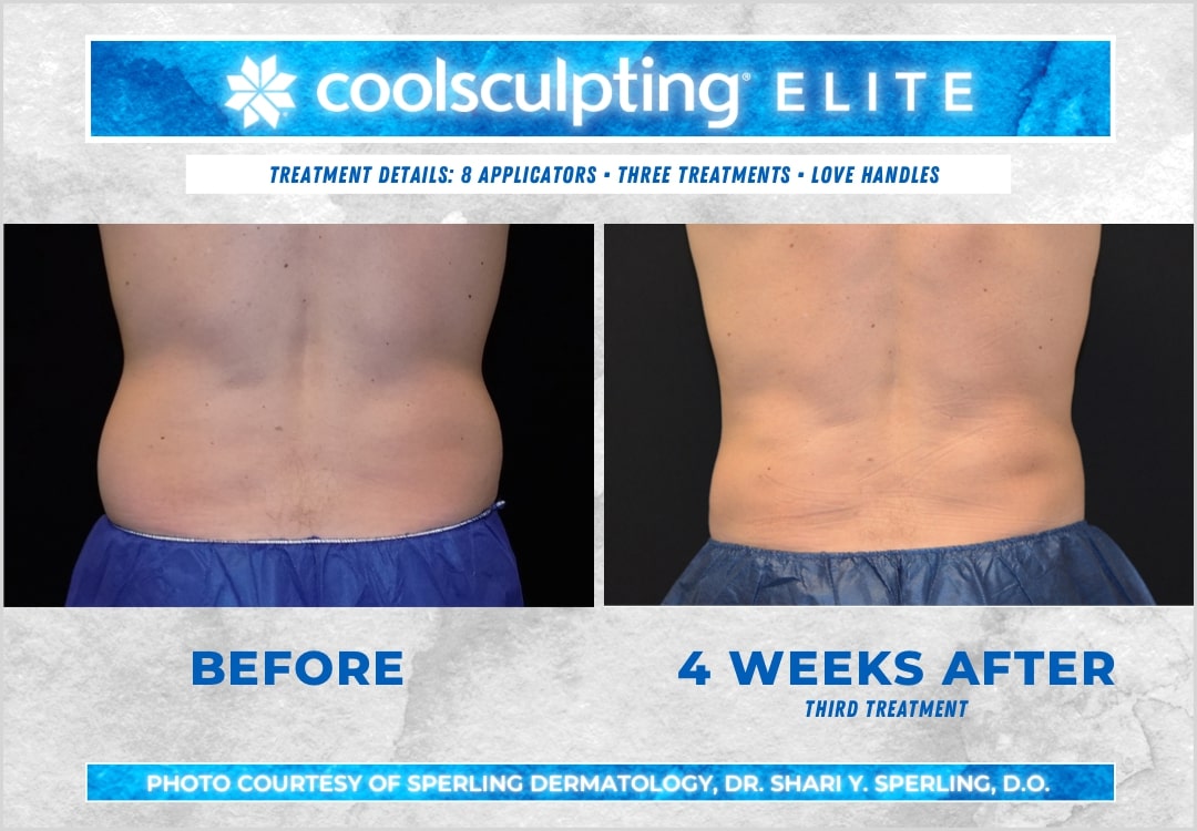 Before & After Love Handles CoolSculpting in New Jersey