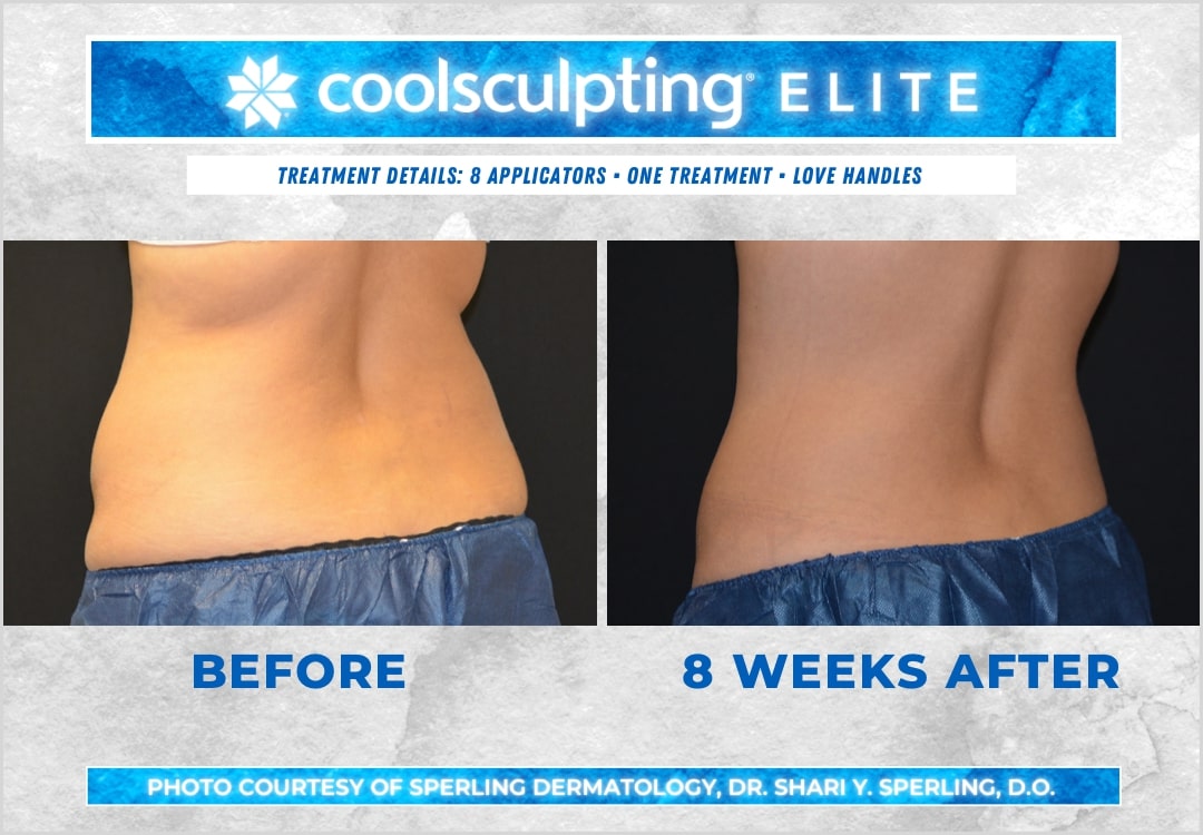 Before & After Love Handles CoolSculpting in New Jersey