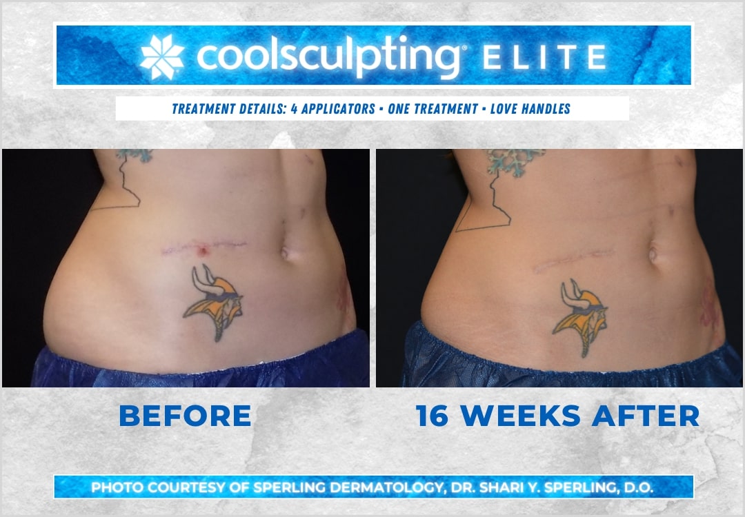 Before & After Love Handles CoolSculpting in New Jersey