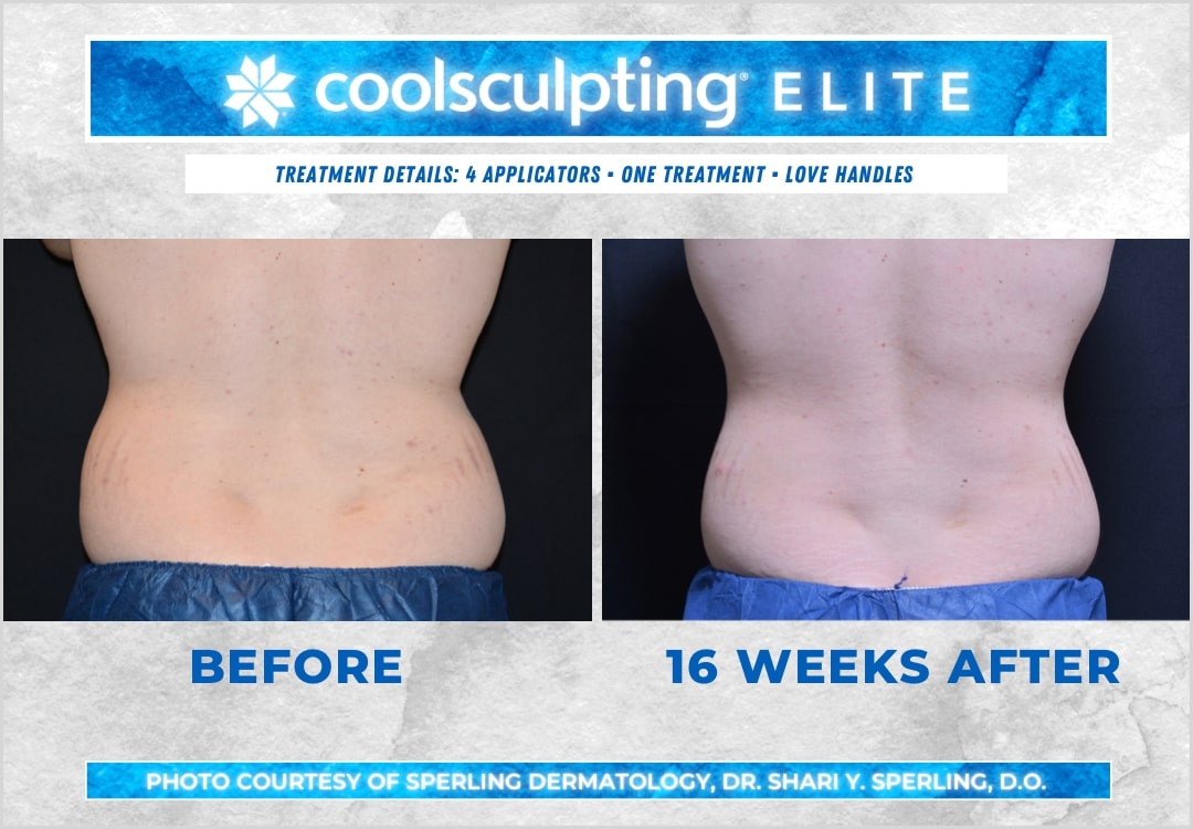 Before & After Love Handles CoolSculpting in New Jersey