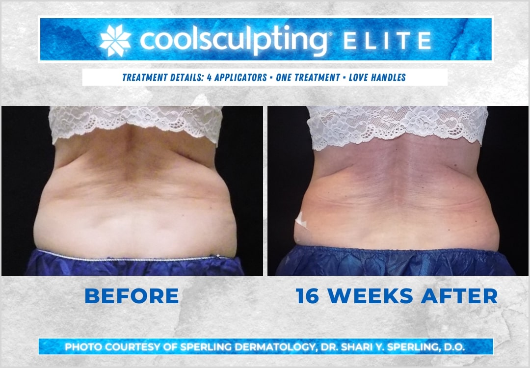 Before & After Love Handles CoolSculpting in New Jersey