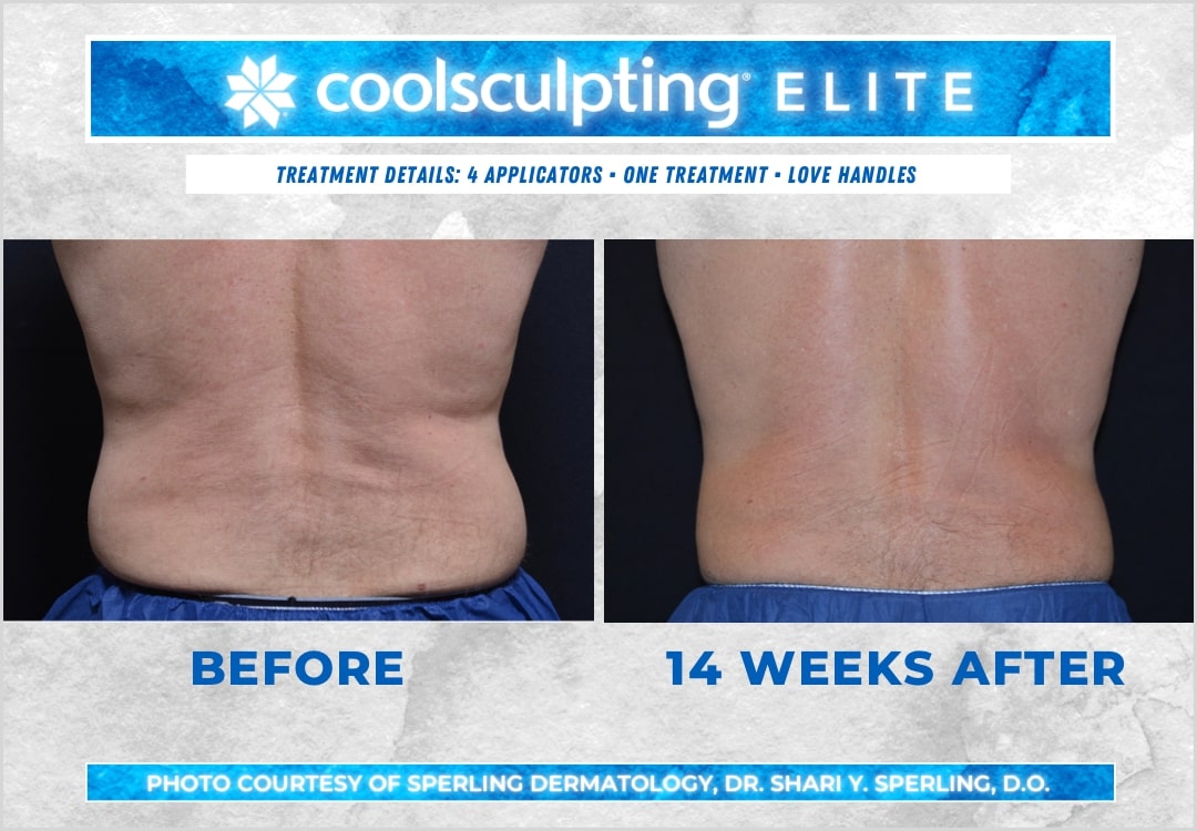 Before & After Love Handles CoolSculpting in New Jersey