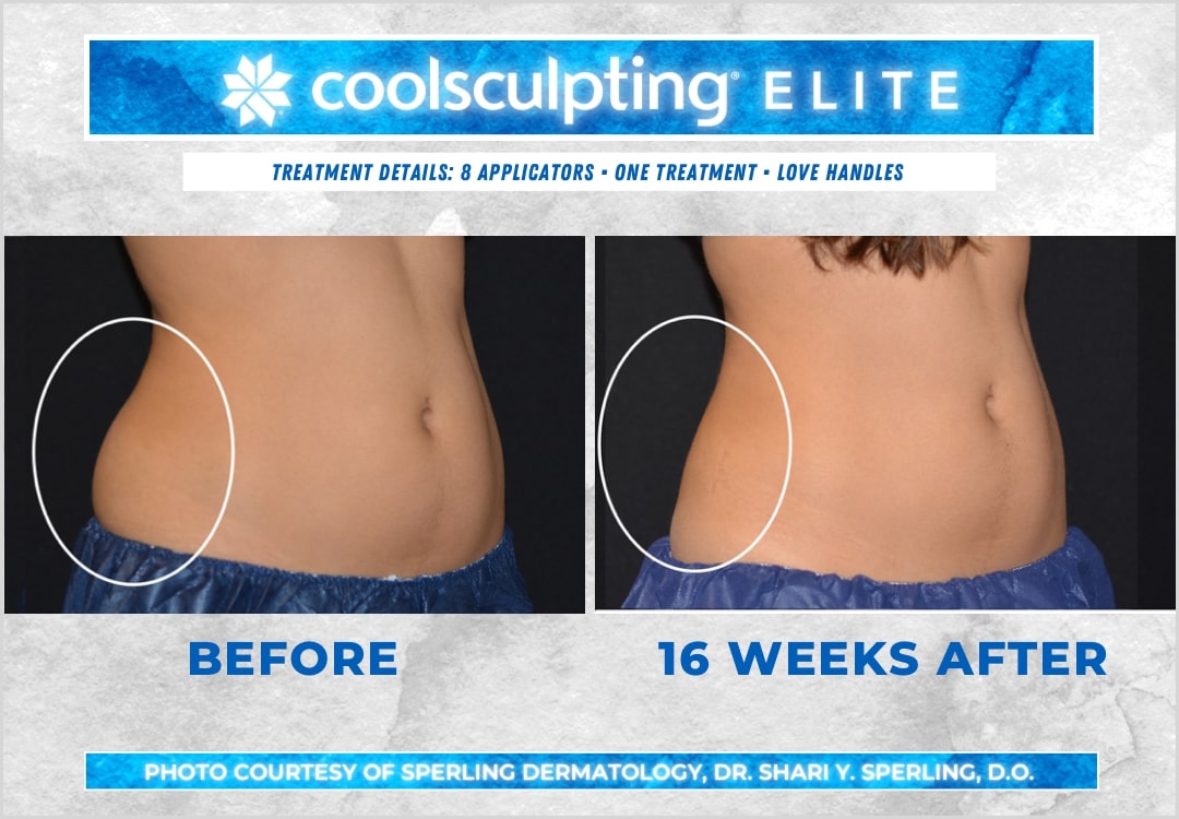 Before & After Love Handles CoolSculpting in New Jersey