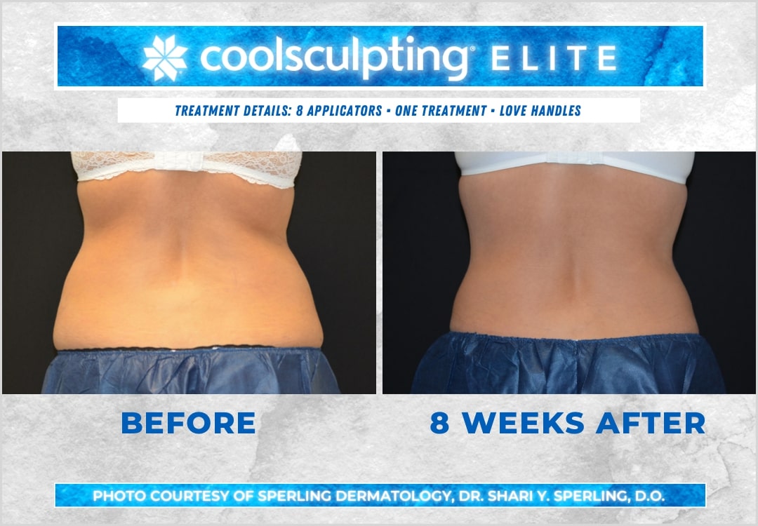 Before & After Love Handles CoolSculpting in New Jersey