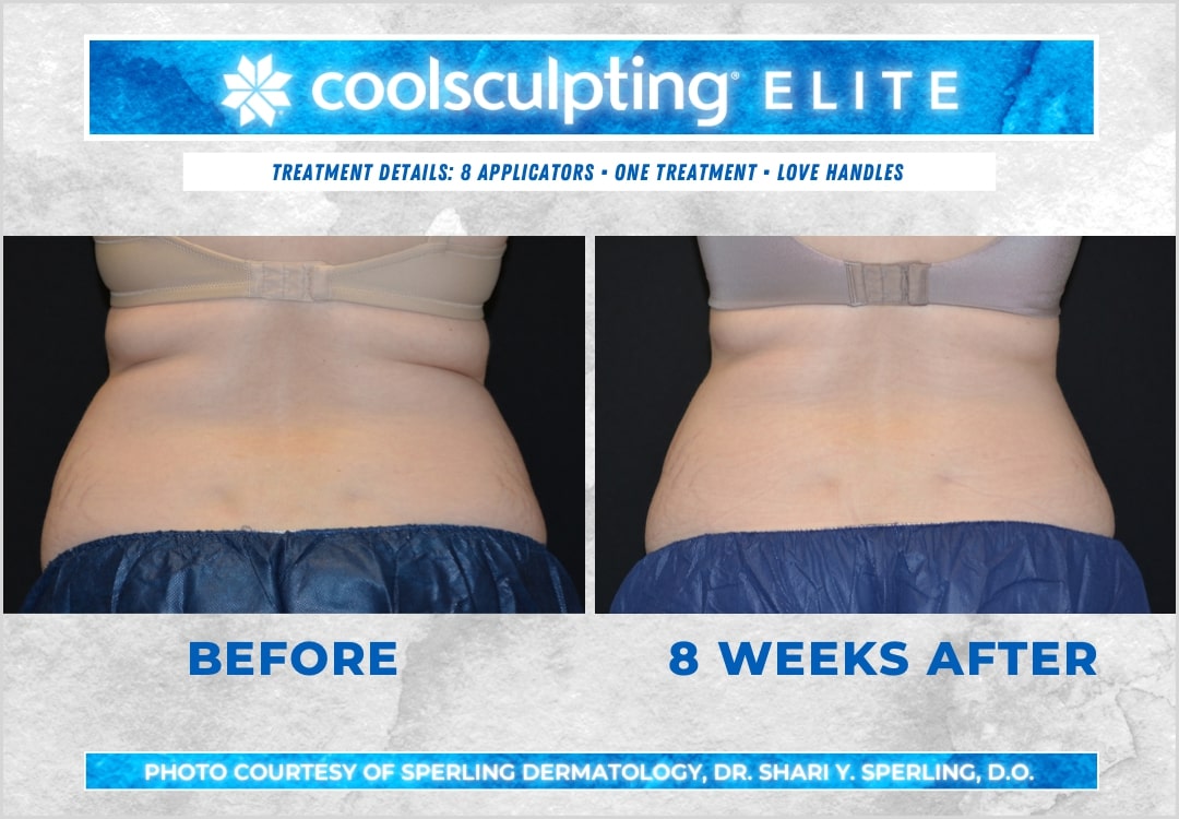 Before & After Love Handles CoolSculpting in New Jersey