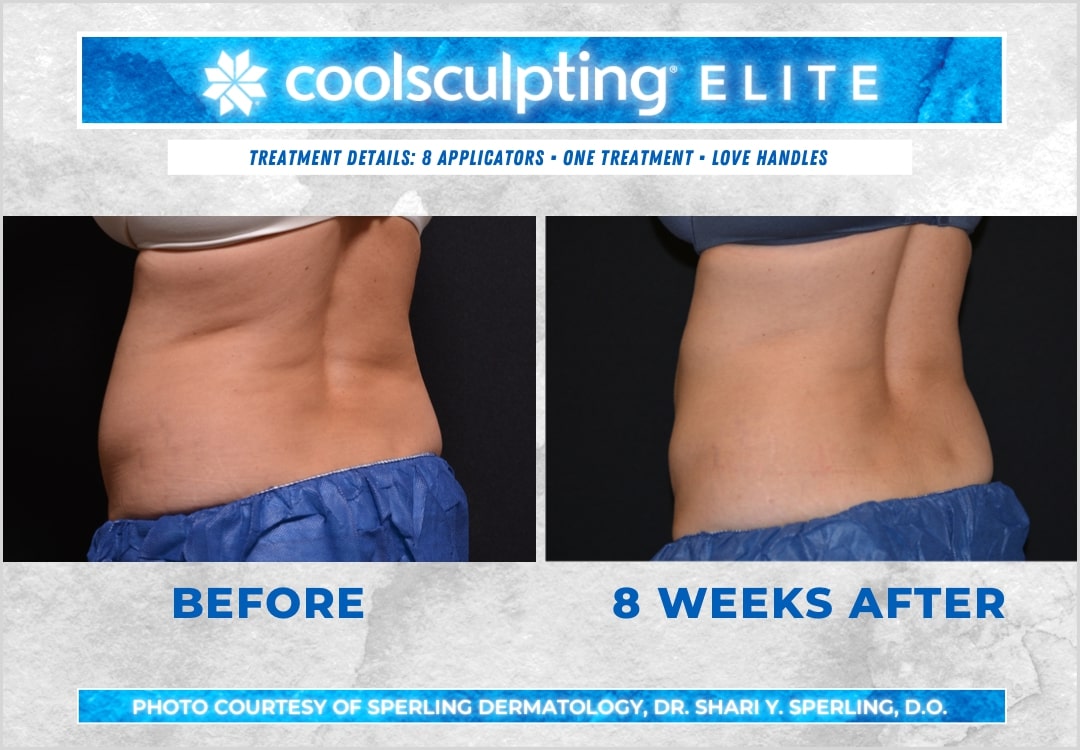 Before & After Love Handles CoolSculpting in New Jersey