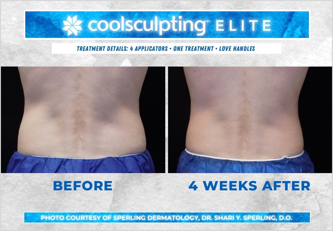 Before & After Love Handles CoolSculpting in New Jersey