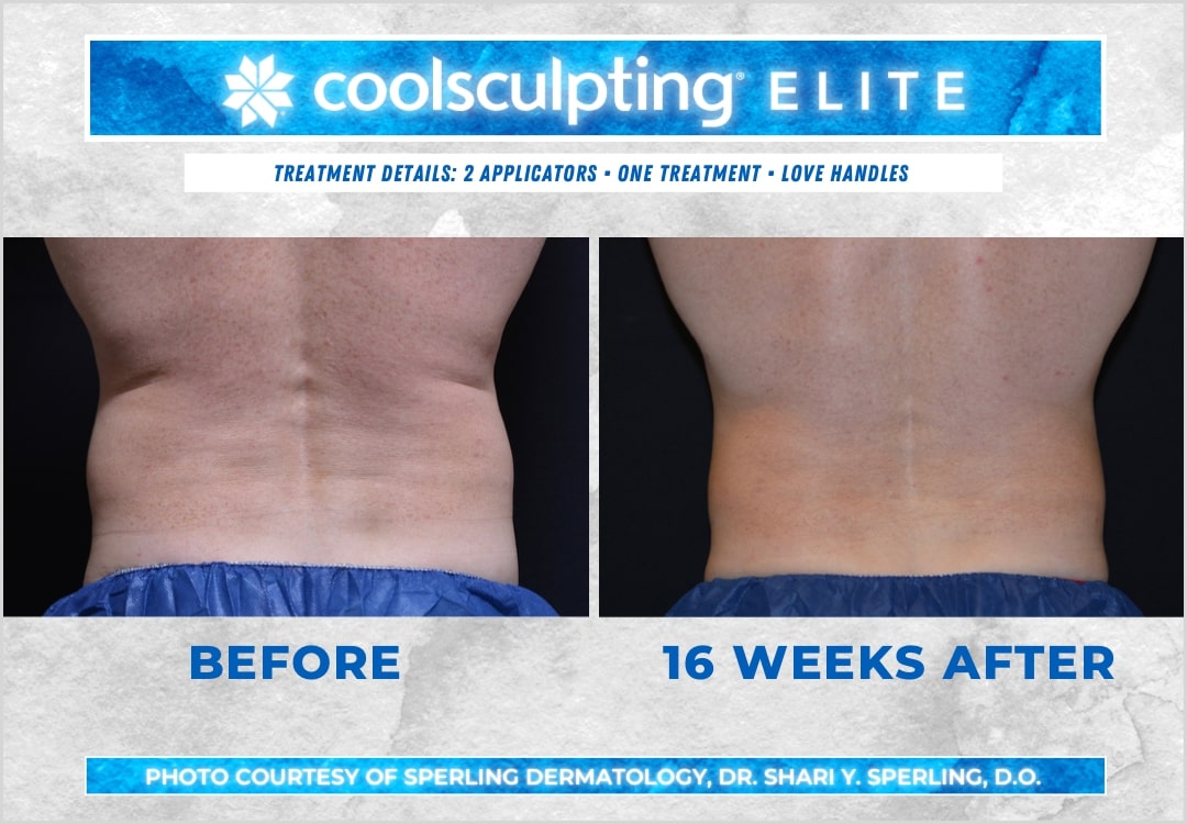 Before & After Love Handles CoolSculpting in New Jersey