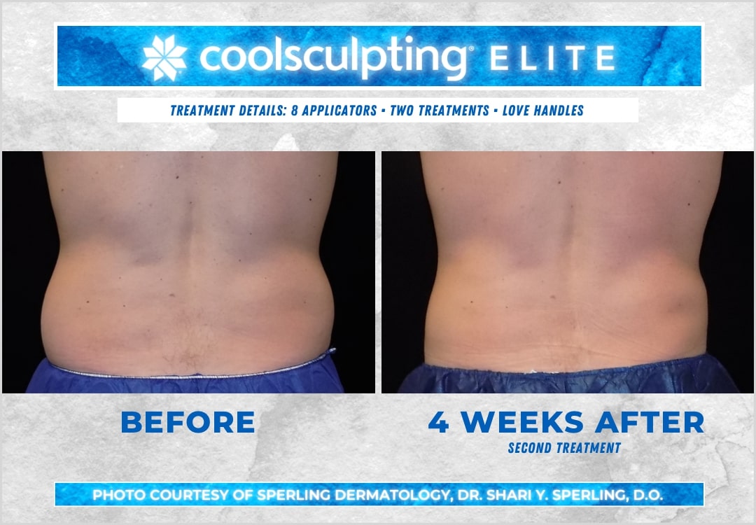 Before & After Love Handles CoolSculpting in New Jersey