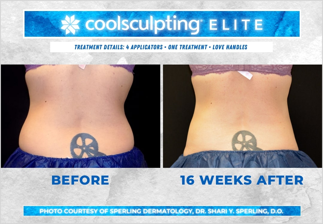 Before & After Love Handles CoolSculpting in New Jersey