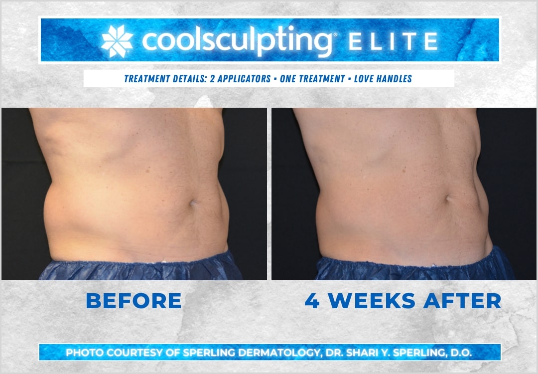 Before & After Love Handles CoolSculpting in New Jersey