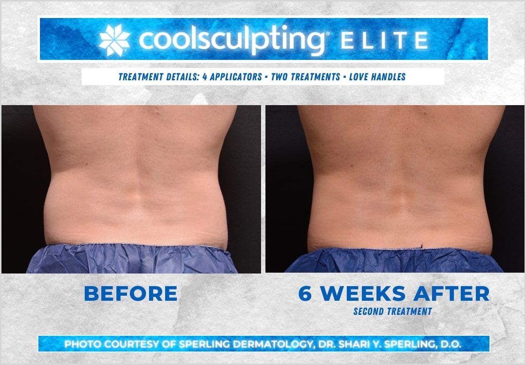 Before & After Love Handles CoolSculpting in New Jersey