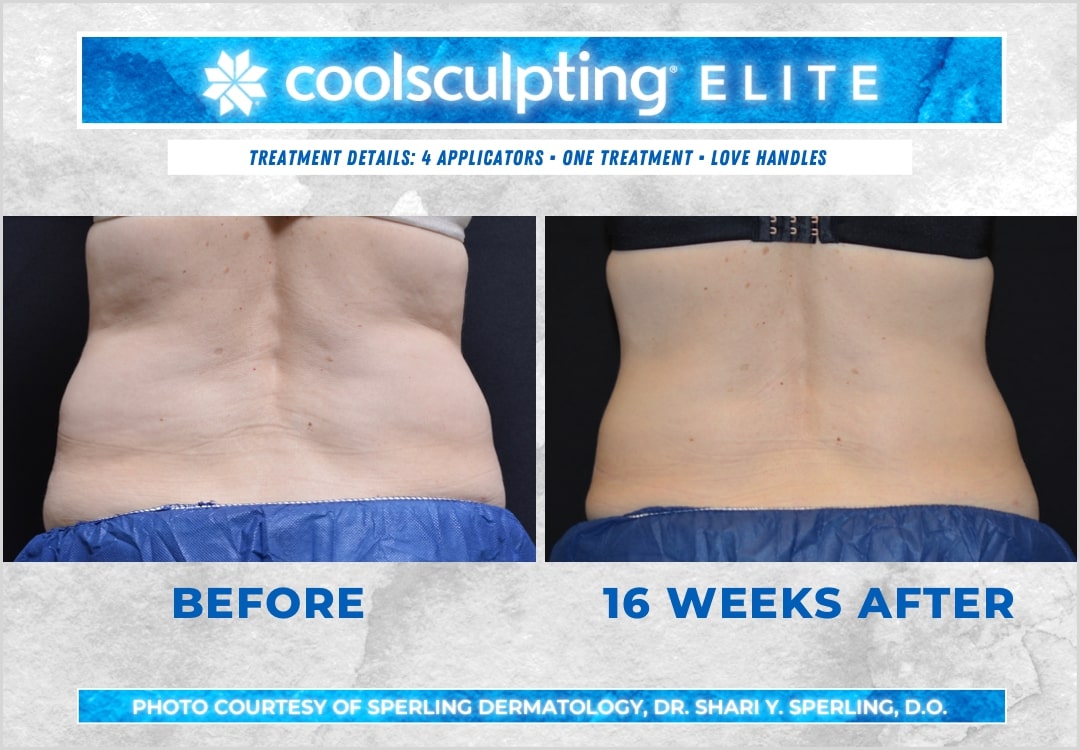 Before & After Love Handles CoolSculpting in New Jersey