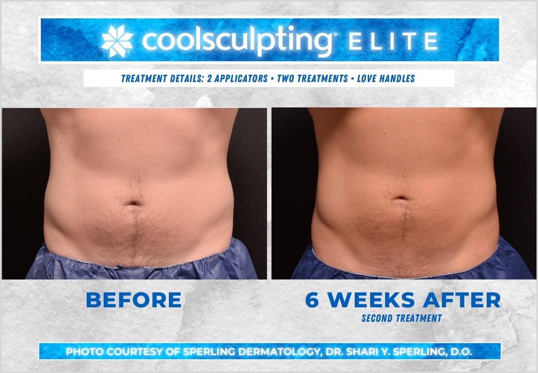 Before & After Love Handles CoolSculpting in New Jersey