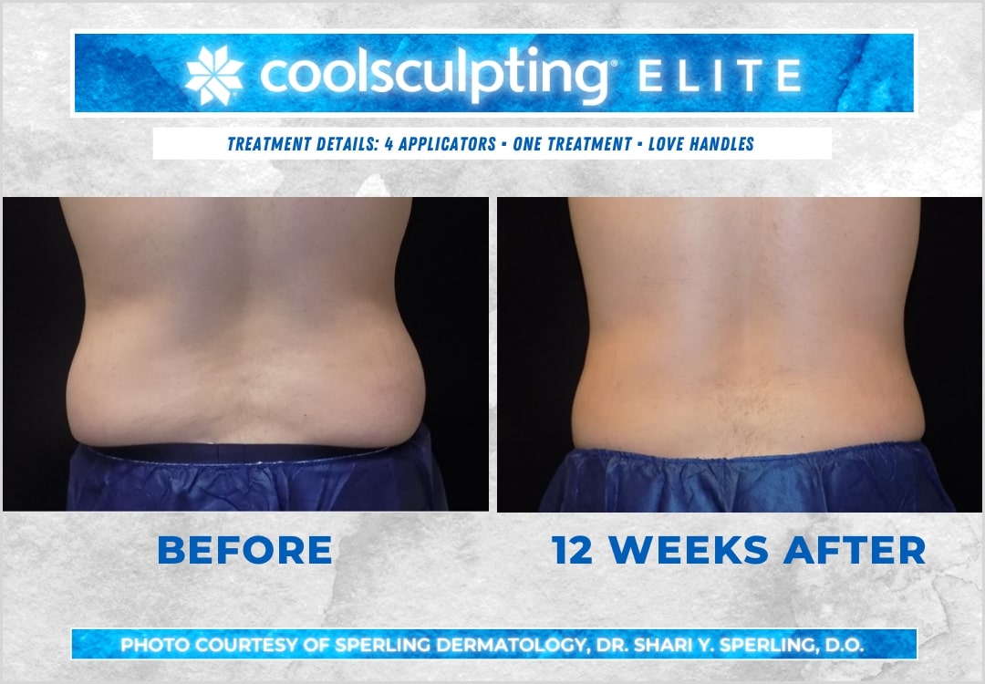 Before & After Love Handles CoolSculpting in New Jersey