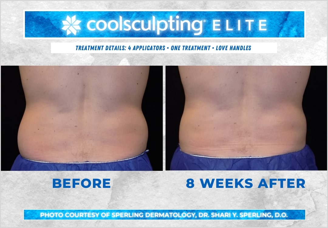 Before & After Love Handles CoolSculpting in New Jersey