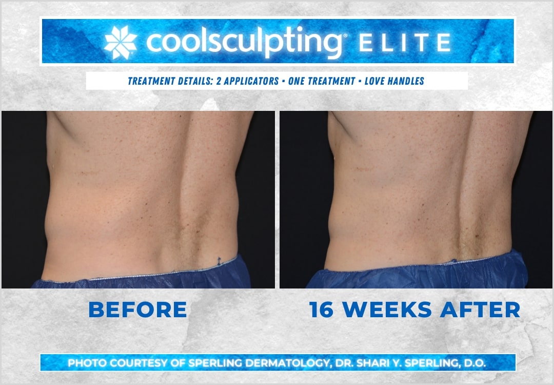 Before & After Love Handles CoolSculpting in New Jersey