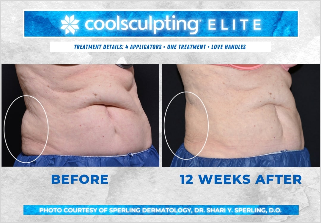 Before & After Love Handles CoolSculpting in New Jersey