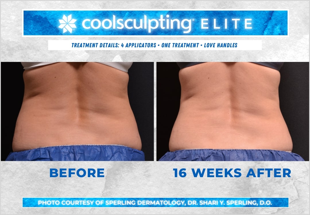 Before & After Love Handles CoolSculpting in New Jersey