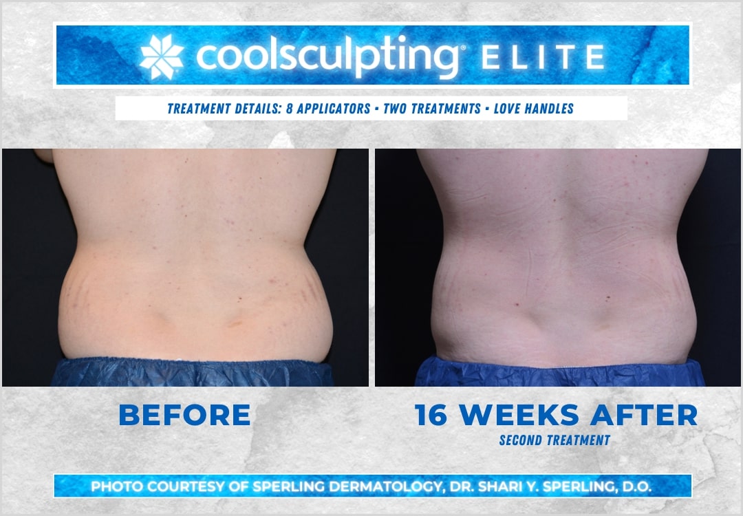 Before & After Love Handles CoolSculpting in New Jersey