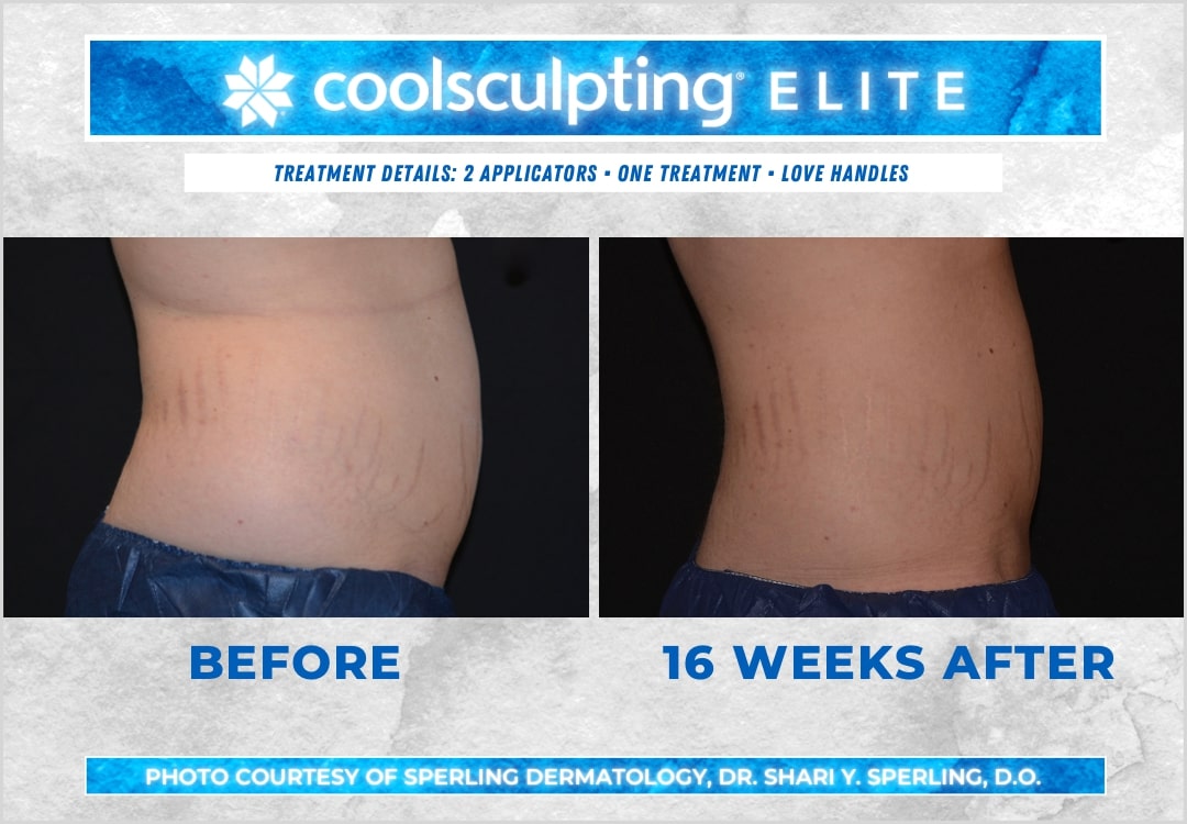 Before & After Love Handles CoolSculpting in New Jersey