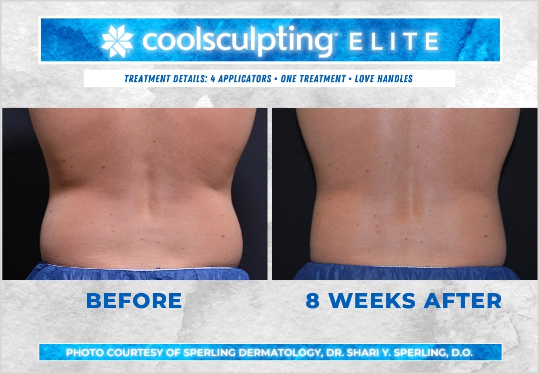 Before & After Love Handles CoolSculpting in New Jersey