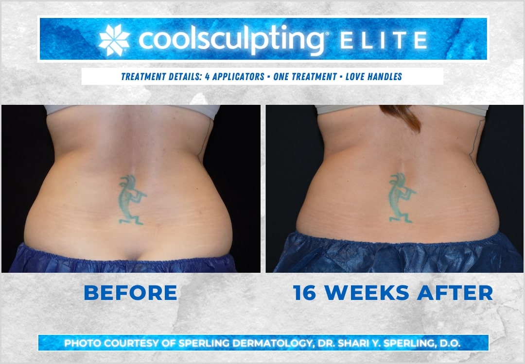 Before & After Love Handles CoolSculpting in New Jersey