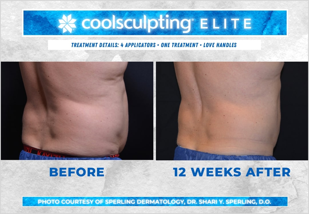 Before & After Love Handles CoolSculpting in New Jersey