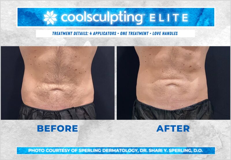 Before & After Love Handles CoolSculpting in New Jersey