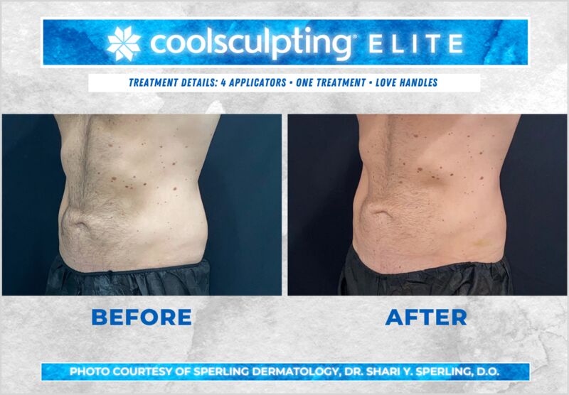 Before & After Love Handles CoolSculpting in New Jersey