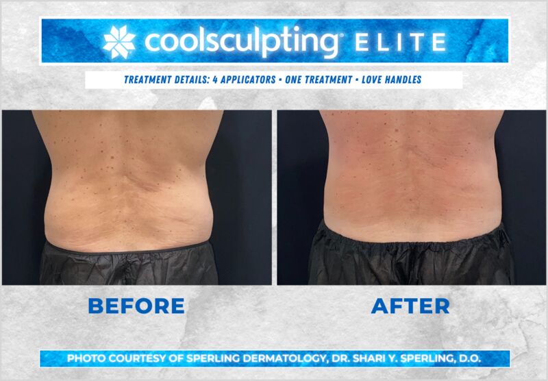 Before & After Love Handles CoolSculpting in New Jersey